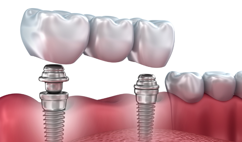 3d lower teeth and dental implant isolated on white