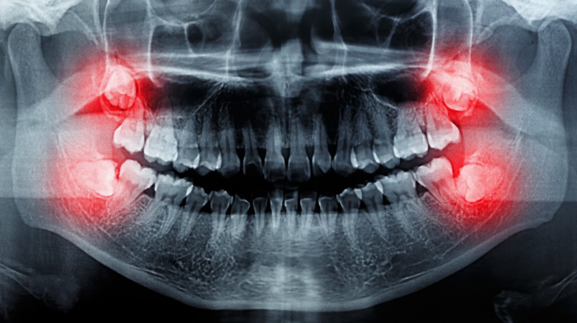 film X-Ray scan human Wiesheitszähne auf einer Panoramaröntgenaufnahme