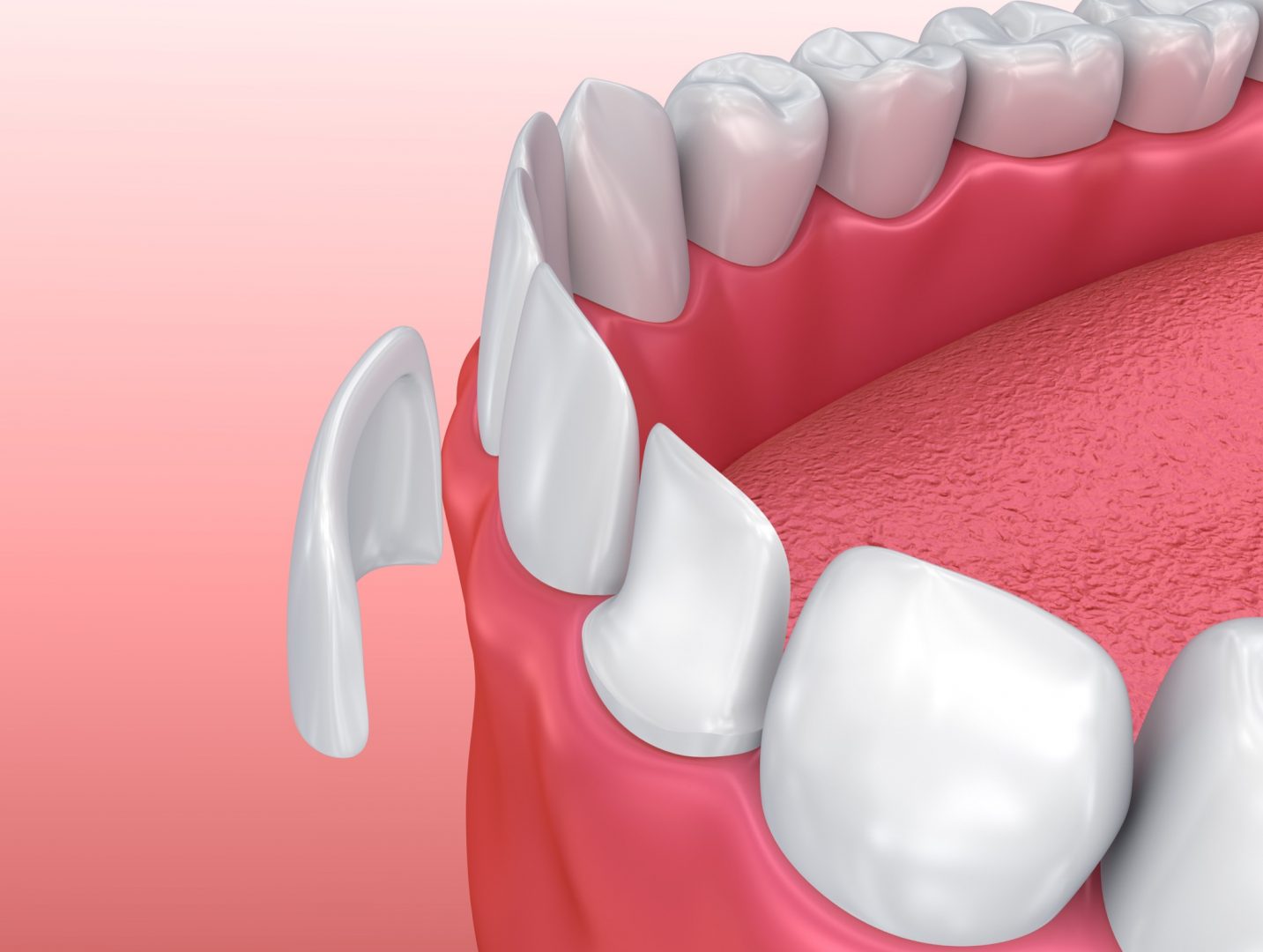 Dental Veneers: Porcelain Veneer installation Procedure. 3D illustration Veneer aus Vollkeramik