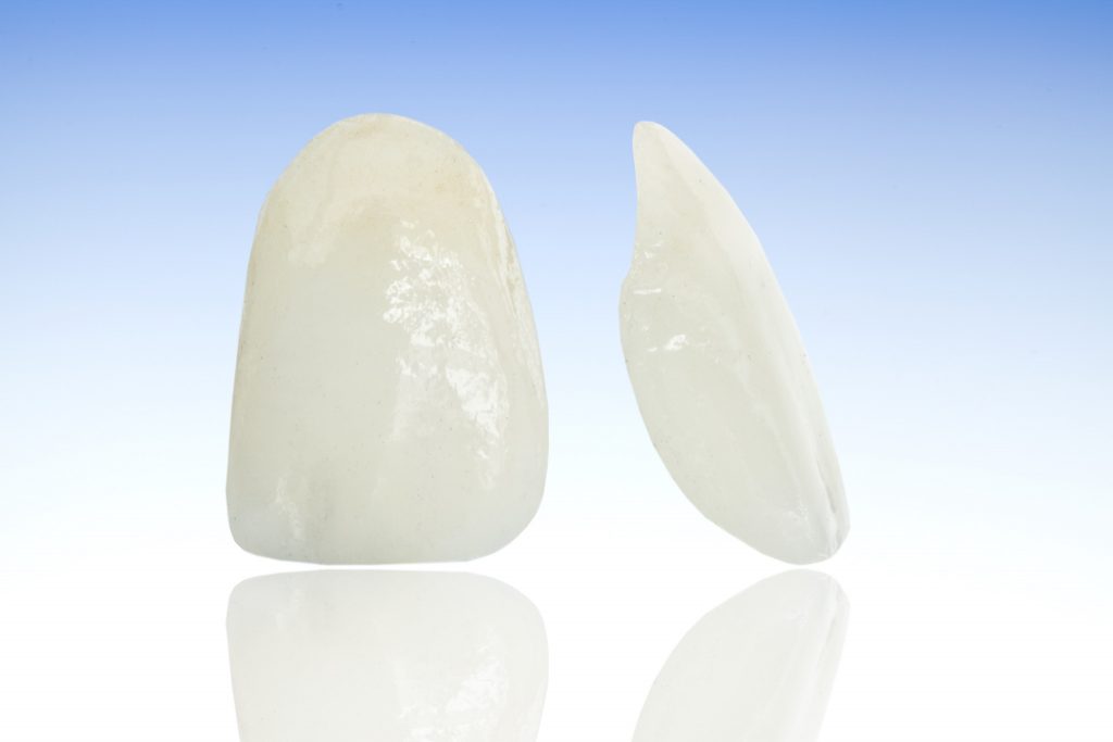 Vollkeramik Veneer