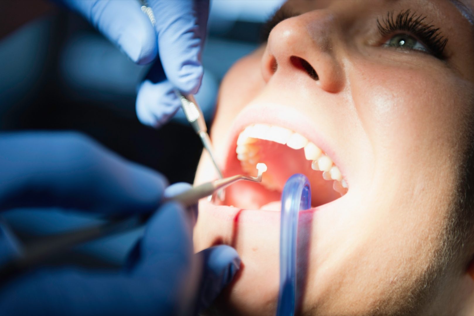 Dentist doing dental filling tooth in dentist office Einsetzen von Kompositfüllung