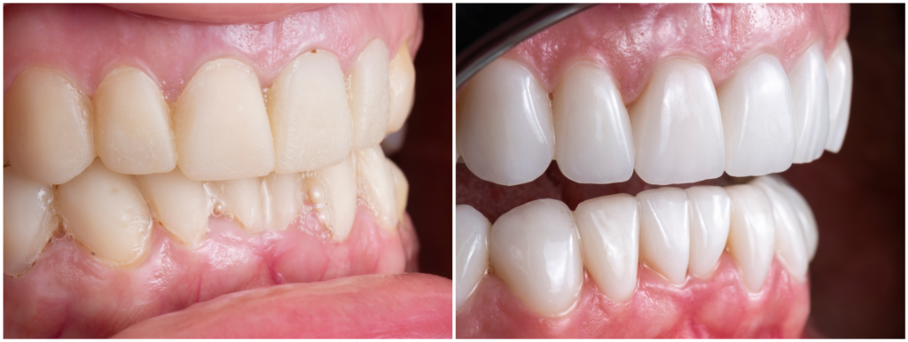 Veneer