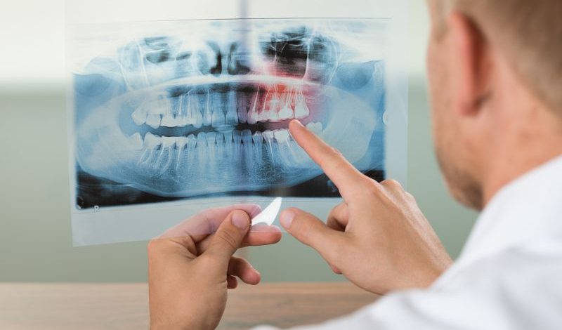 bone-graft-01