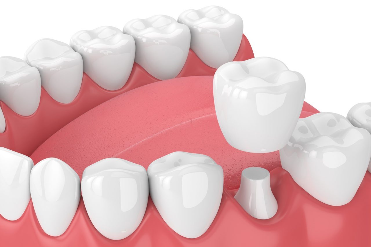 Evergreen-Dental-Dental-crown-1620x1080px