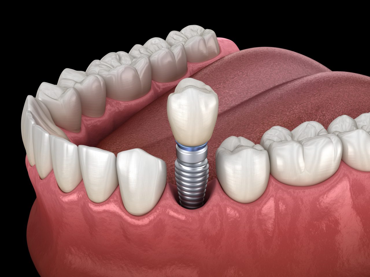 Dental_Implant