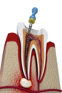 Root_Canal1