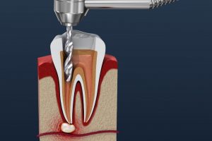 Root_Canal3
