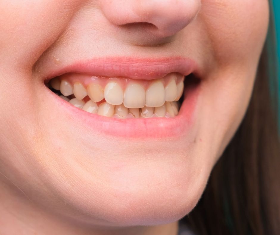 Smoker_teeth
