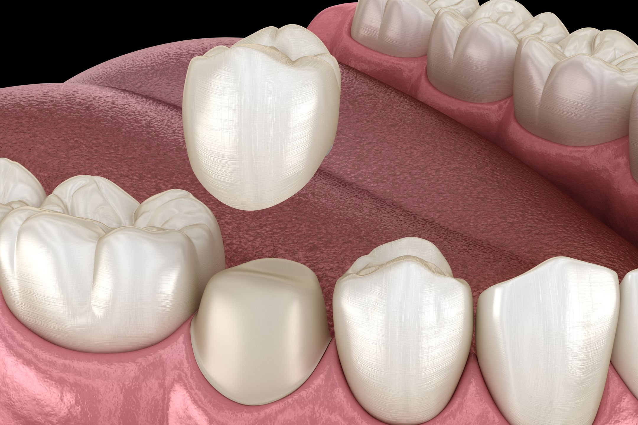 Dental Crown