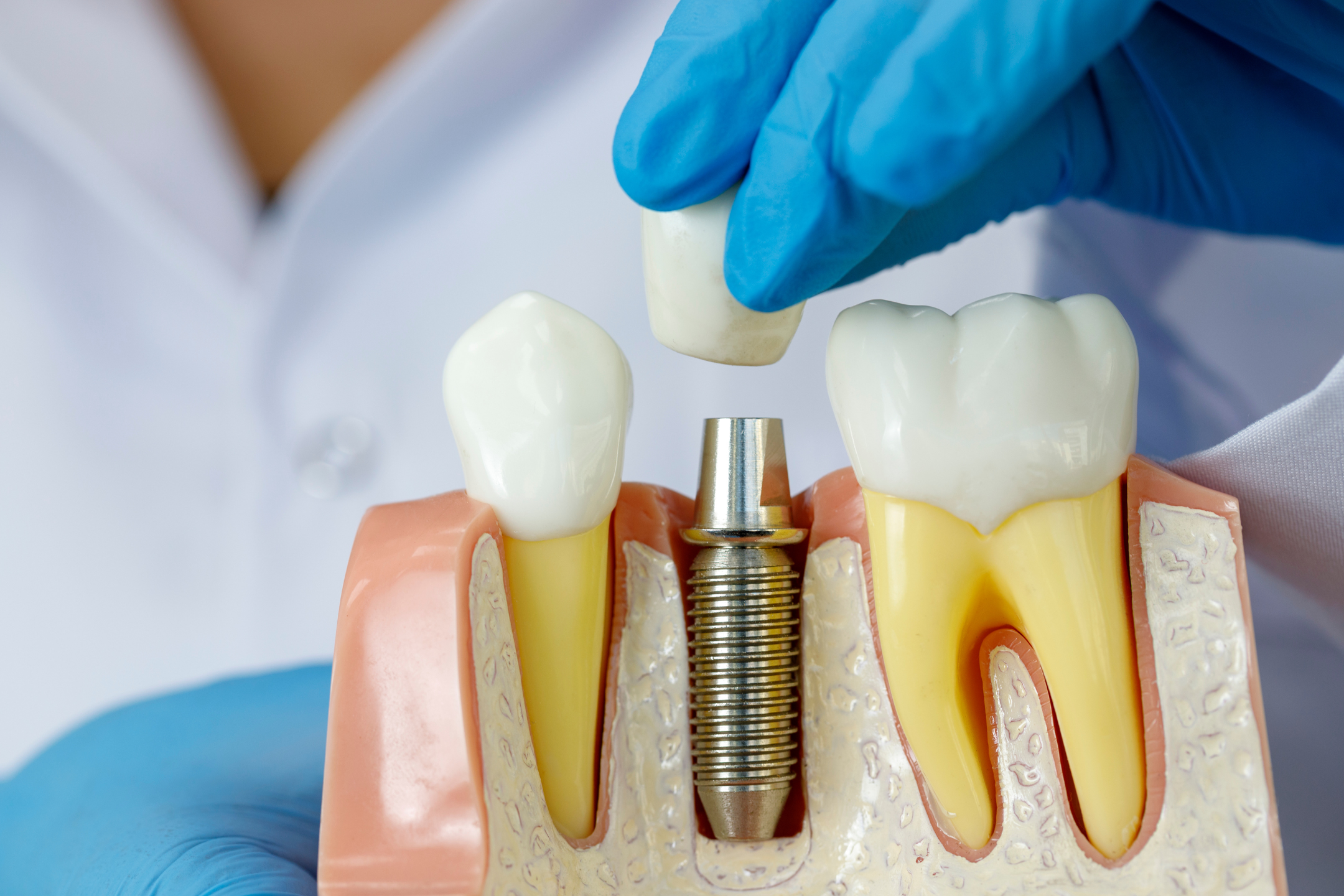 Dental implant model