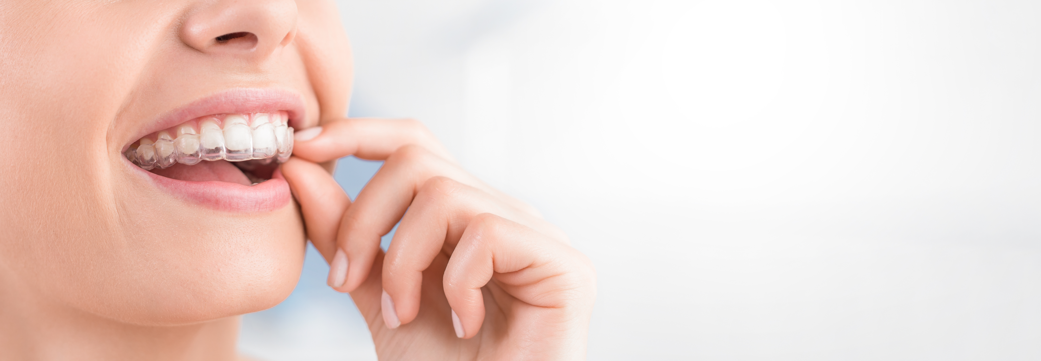 Invisalign clear aligner