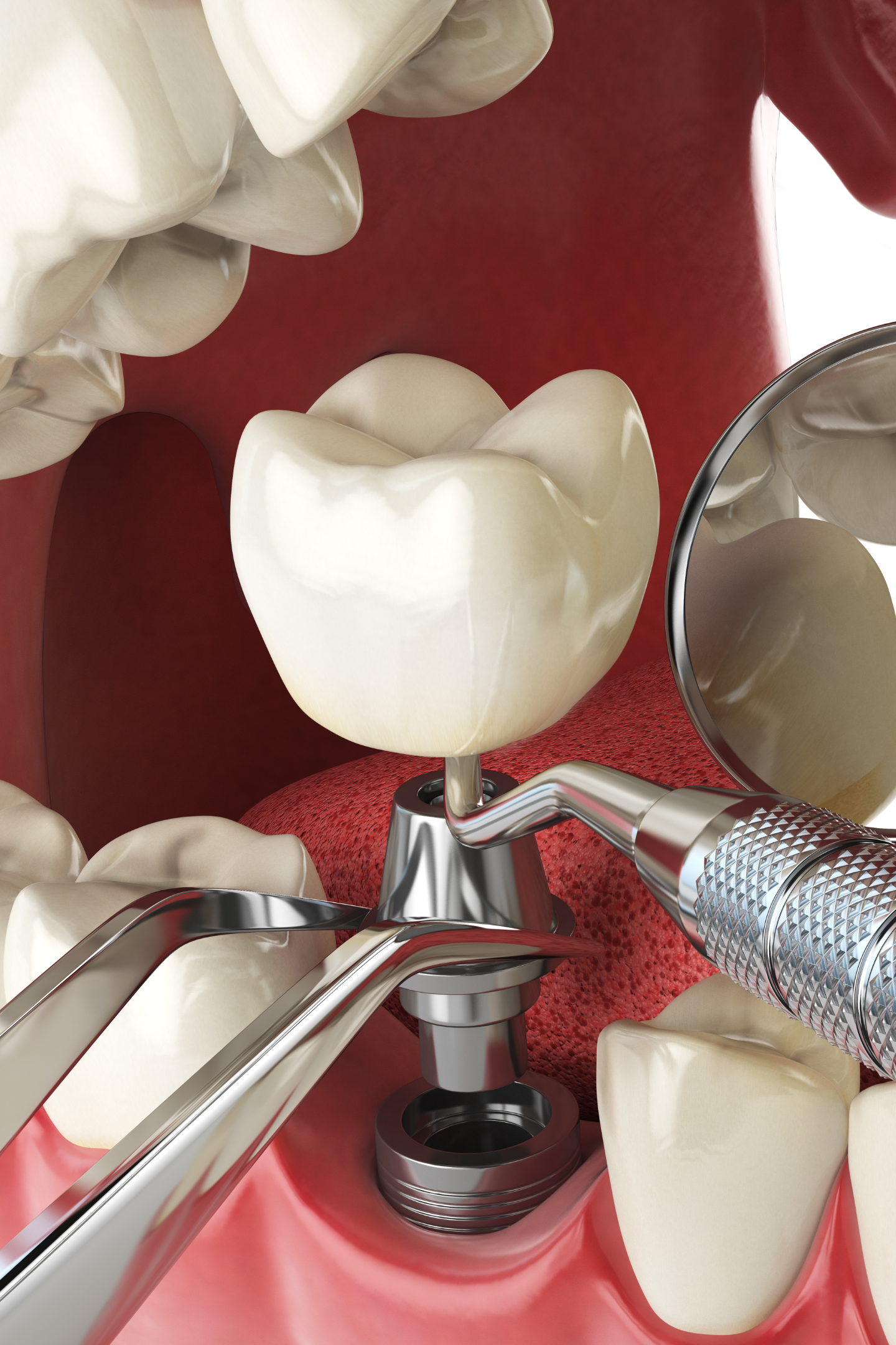 Fogászati implantátum illusztráció