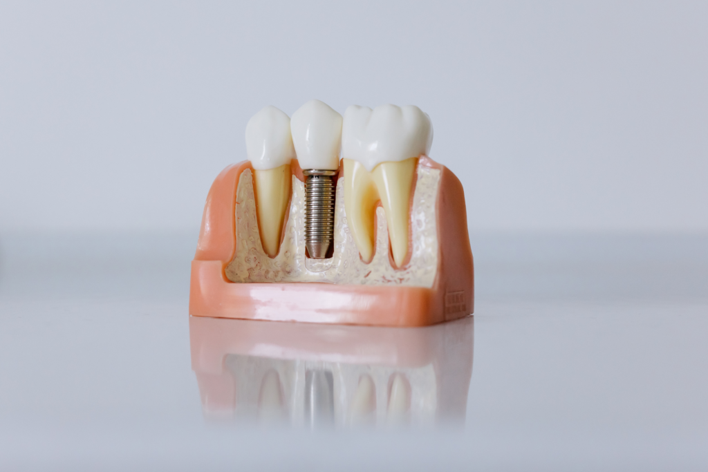 dental implant model