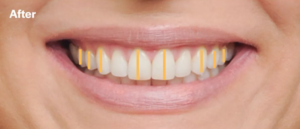 upright_teeth_after after