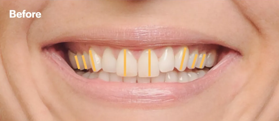 upright_teeth_before before