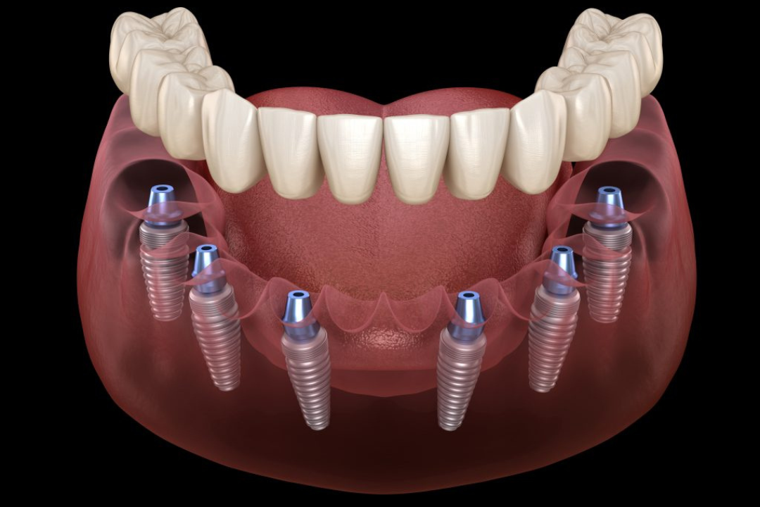 All-on-6 dental implants